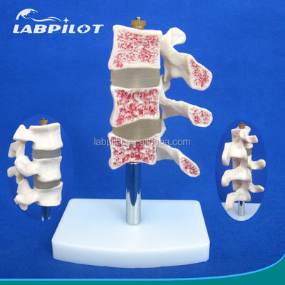 Modelos educativos avanzados de PVC Cutaway Osteoporosis de la columna vertebral Lesiones de la vértebra lumbar