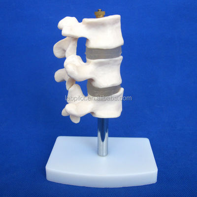 Modelos educativos avanzados de PVC Cutaway Osteoporosis de la columna vertebral Lesiones de la vértebra lumbar