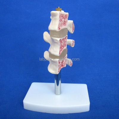 Modelos educativos avanzados de PVC Cutaway Osteoporosis de la columna vertebral Lesiones de la vértebra lumbar