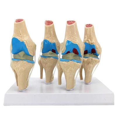 Demostración anatómica del modelo de patología articular de la rodilla humana para la ciencia médica