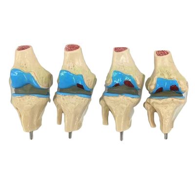 Demostración anatómica del modelo de patología articular de la rodilla humana para la ciencia médica