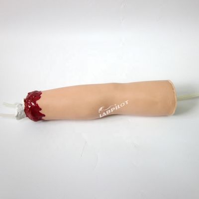 Modelo de cuidados de enfermería de trauma Amputación del brazo y hemostasis para el tratamiento de heridas de extremidades superiores