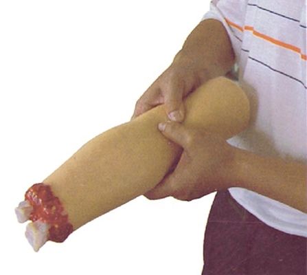 Modelo de cuidados de enfermería de trauma Amputación del brazo y hemostasis para el tratamiento de heridas de extremidades superiores