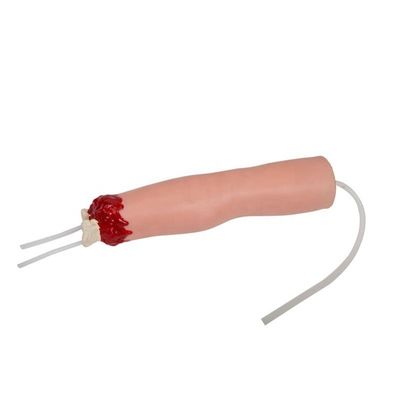 Modelo de cuidados de enfermería de trauma Amputación del brazo y hemostasis para el tratamiento de heridas de extremidades superiores