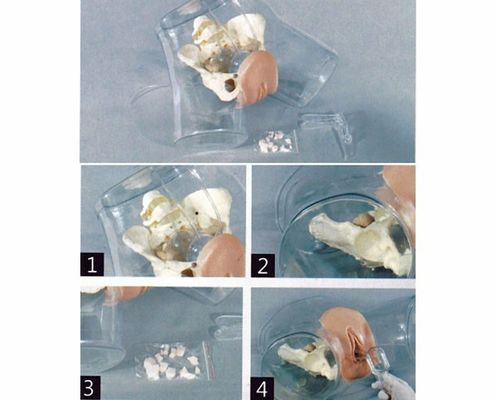 Modelo de Obstetricia-Ginecología Simulador de curetaje uterino transparente para la escuela de enfermería