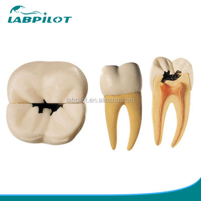 Modelo anatómico de caries dental amplificada 16 veces Modelo para la educación y la enseñanza