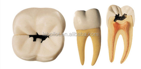 Modelo anatómico de caries dental amplificada 16 veces Modelo para la educación y la enseñanza