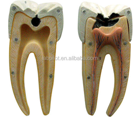 Modelo anatómico de caries dental amplificada 16 veces Modelo para la educación y la enseñanza