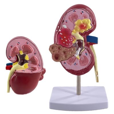 Modelo de riñón patológico de PVC para escuelas de medicina y hospitales de urología