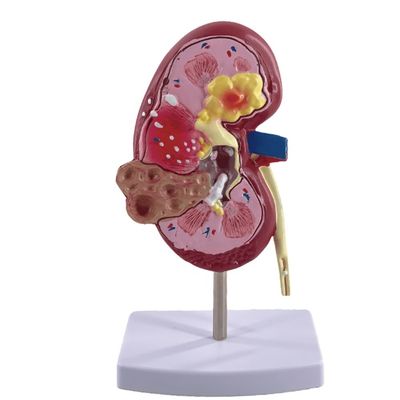 Modelo de riñón patológico de PVC para escuelas de medicina y hospitales de urología