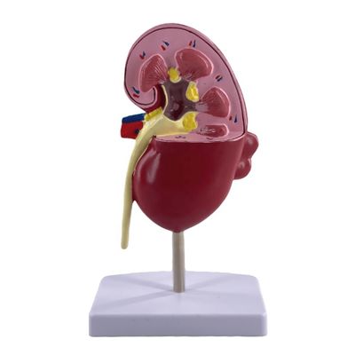 Modelo de riñón patológico de PVC para escuelas de medicina y hospitales de urología