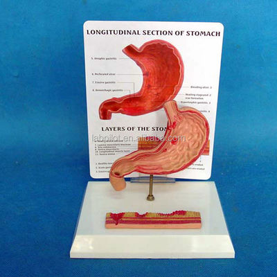 Modelo educativo avanzado de PVC para la representación de úlceras gástricas y úlceras estomacales humanas
