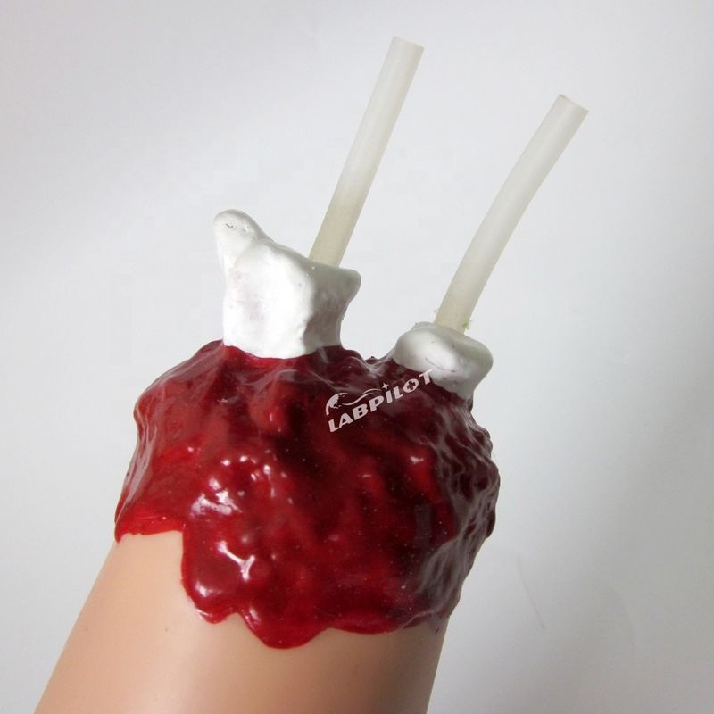 Modelo de cuidados de enfermería de trauma Amputación del brazo y hemostasis para el tratamiento de heridas de extremidades superiores